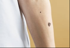 Cáncer de piel: recomendaciones para prevenir, cómo detectar a tiempo y síntomas